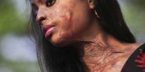 هندي يحرق وجه فتاة بالماء المغلي لأنها ألغت صداقته على فيسبوك