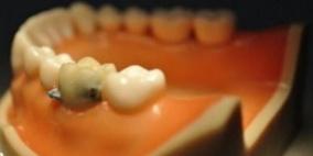 ابتكار أسنان ذكية تراقب طعامك وشرابك لاخبار طبيبك