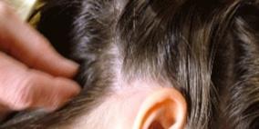 نصائح لحماية الأطفال من الإصابة بقمل الرأس