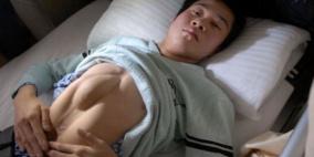 جراحة ناجحة لحلاق صيني لتعديل مكان قلبه الموجود في بطنه