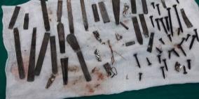 حدث في غزة.. استخراج "ورشة حدادة" من معدة مريض