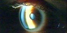 مكمل غذائى جديد للوقاية من اضطراب النظر