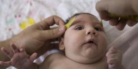 البرازيل تسجل 5200 حالة إصابة بصغر الرأس بسبب زيكا