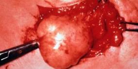 غاز النيتروجين السائل يقضى على أورام العظام الحميدة