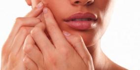 مرض وردية الوجه.. أسبابه وطرق علاجه