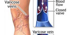 المرأة أكثر إصابة بـ"دوالى الساقين" من الرجل