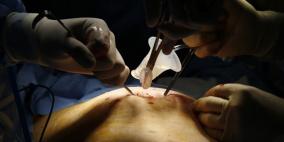 اشتعال النار بمعدة بريطاني أثناء عملية جراحية