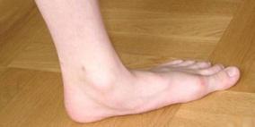 كيف يتم علاج قرحة القدم؟