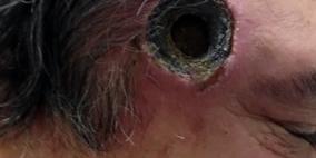 مرهم عشبي للجلد يحدث ثقبا في رأس رجل