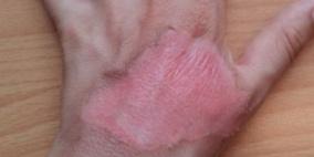 أهم الإسعافات الأولية فى حالات الإصابة بحروق مفاجئة