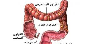 الإهمال في علاج لحميات القولون يحولها لأورام خبيثة