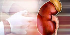 هل يمكن لمريض الكلى الصوم؟