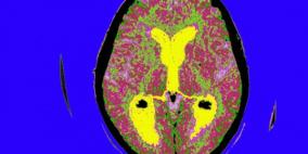 فقدان الذاكرة ليس مؤشرا أكيدا على الزهايمر