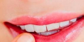 خلطات طبيعية لعلاج تشقق الشفاه