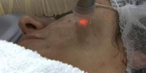 تقنية الليزر آمنة لعلاج حب الشباب