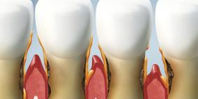 أطباء الأسنان البريطانيون يستغربون لندرة حالات الفساد حول أسنان سكان بريطانيا القدامى