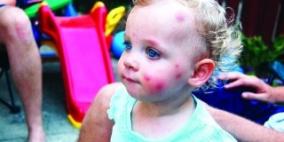 جيناتنا تحدد تكرار تعرضنا للدغات البعوض