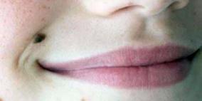 الجراحة.. الحل الوحيد للتخلص من الحسنة الخبيثة