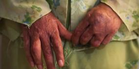 طفلة إيرانية تشعل النار بجسدها هربا من الزواج وتطلب اللجوء في بريطانيا