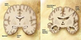 مسح فائق الدقة بالأشعة يحدد موضع بداية الزهايمر ويُتابع انتشاره