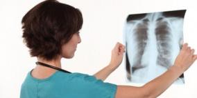 تطوير اختبار تنفسي أولي لكشف الإصابة بالسل