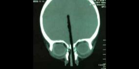طفل صيني يتجنب الموت بعد اختراق عصاة الطعام دماغه عبر أنفه