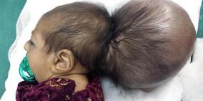 أطباء أفغان يستأصلون "رأسا ثانيا" من جمجمة طفلة