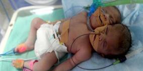 غزة: وفاة طفل ولد برأسين بعد أسبوع من ولادته