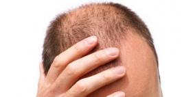 علماء ينجحون في تجارب قد تقضي على الصلع نهائياً