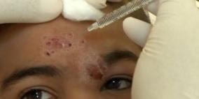 ذبابة في لبنان تصيب 350 شخصا بمرض يعرف بـ"حبة حلب"