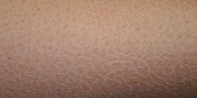 السبانخ والبقدونس والفاكهة تحمى الجلد من التشقق فى فصل الشتاء