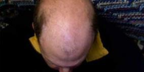 الضغوط النفسية تسبب الصلع المبكر