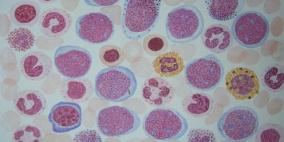 اكتشاف طريقة جديدة لعلاج أحد أنواع سرطان الدم