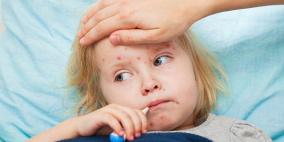 تحذير من خطورة مرض الحصبة على الصحة بعد ارتفاع الوفيات