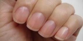 لون أظافرك يكشف حالتك الصحية