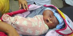 بالصور.. إندونيسية تلد طفلاً برأس على شكل قلب