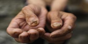 ابتكار دواء لعلاج سرطان الجلد في روسيا