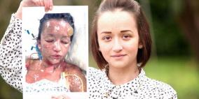 فتاة بريطانية كادت الأقراص المضادة للحموضة تذيب جسمها