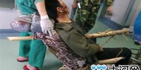 صيني ينجو بأعجوبة من جذع شجرة اخترق جسده