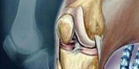 Sarilumab" أمل جديد لعلاج مرضى التهاب المفاصل الروماتويدي