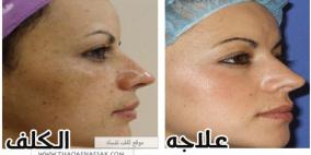 أسباب الكلف وعلاجه للتخلص من بقع الوجه بنية اللون