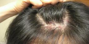 عقار جديد لعلاج الصدفية