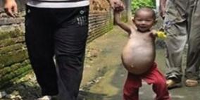 بالصور.. طفل صينى عمره عامان يحمل أخاه التوأم فى معدته