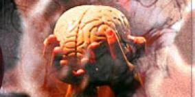 الصداع المتكرر قد يدمر خلايا المخ