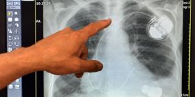 ضخة قلبية صغيرة "قد تغير حياة آلاف المرضى"