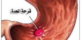 النظام الغذائى لمرضي قرحة المعدة