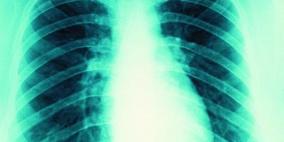 علاج التليّف الكيسي بالجينات