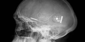 زراعة شريحة إلكترونية بشبكية العين لاثنين من فاقدي البصر