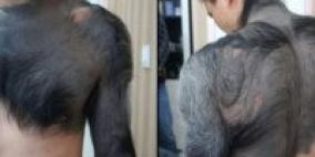 وحمة منذ الولادة تجعل جسم رجل صينى كالقرود