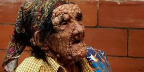 اكتشاف أقدم مرض أصاب البشر